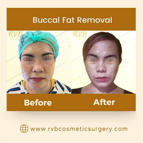 buccal fat removal pris|Buccal Fat Removal in Philippines • Check Prices & Reviews.